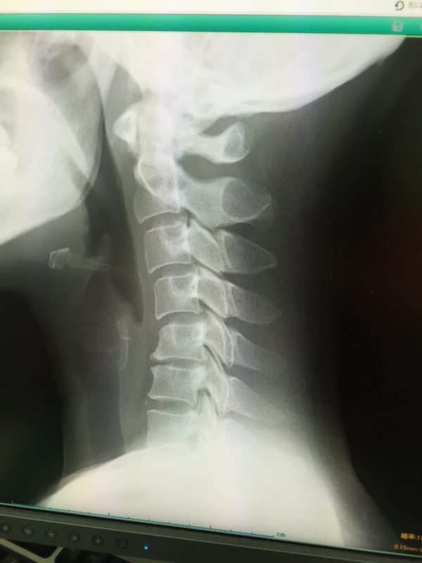ストレートネックのレントゲン画像